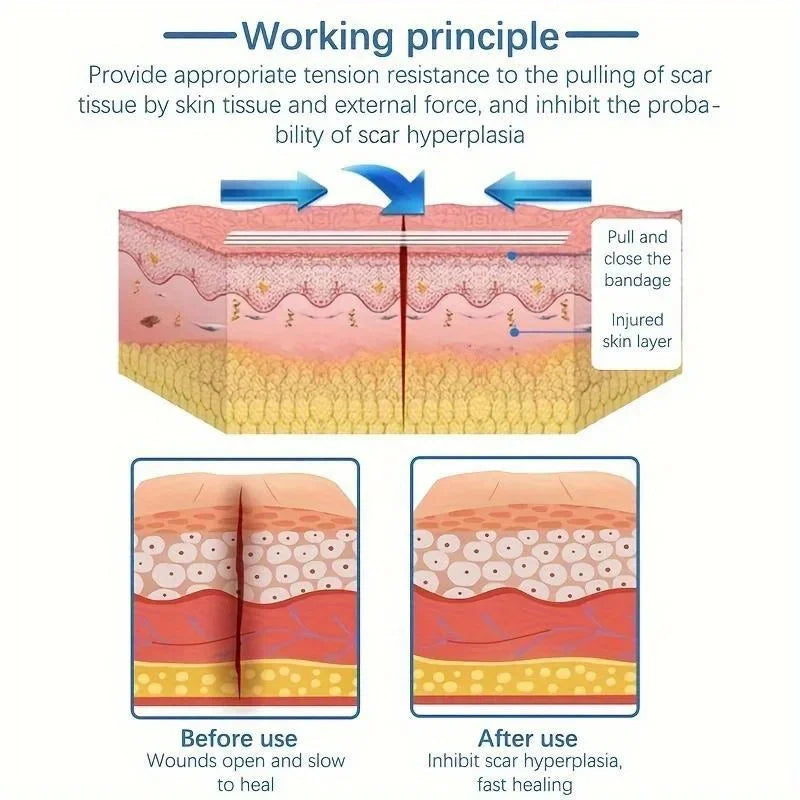 Medical Adhesive Tape Wound Closure