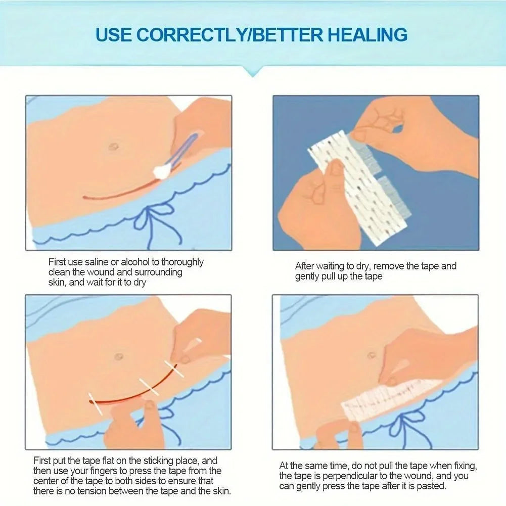 Medical Adhesive Tape Wound Closure