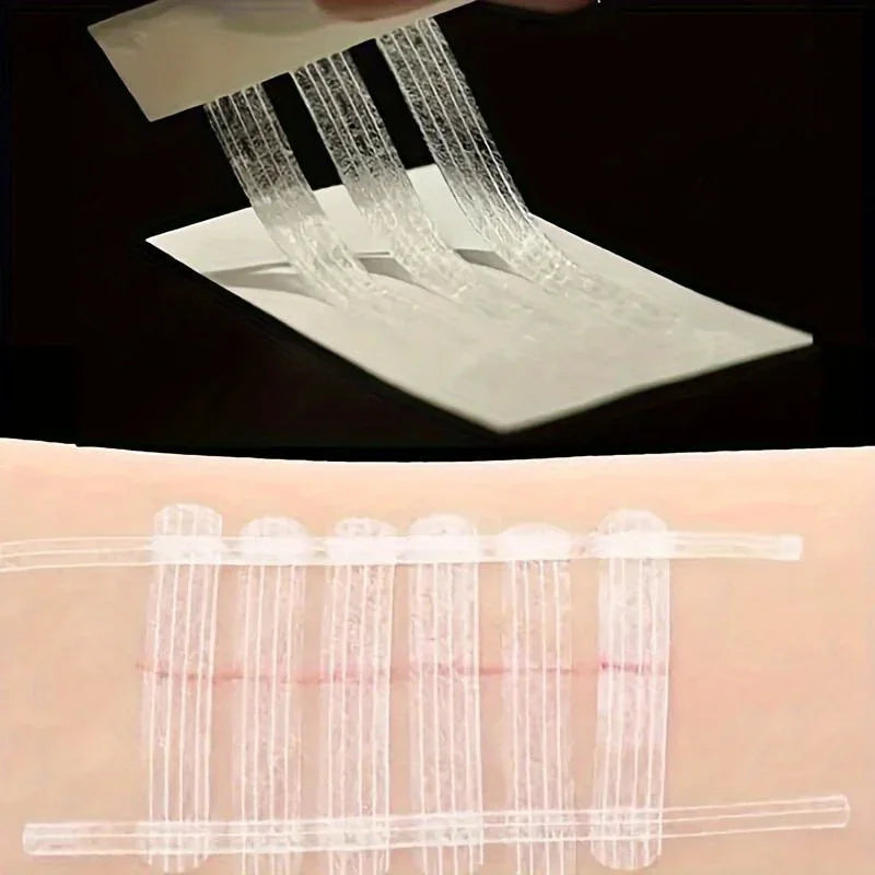 Medical Adhesive Tape Wound Closure